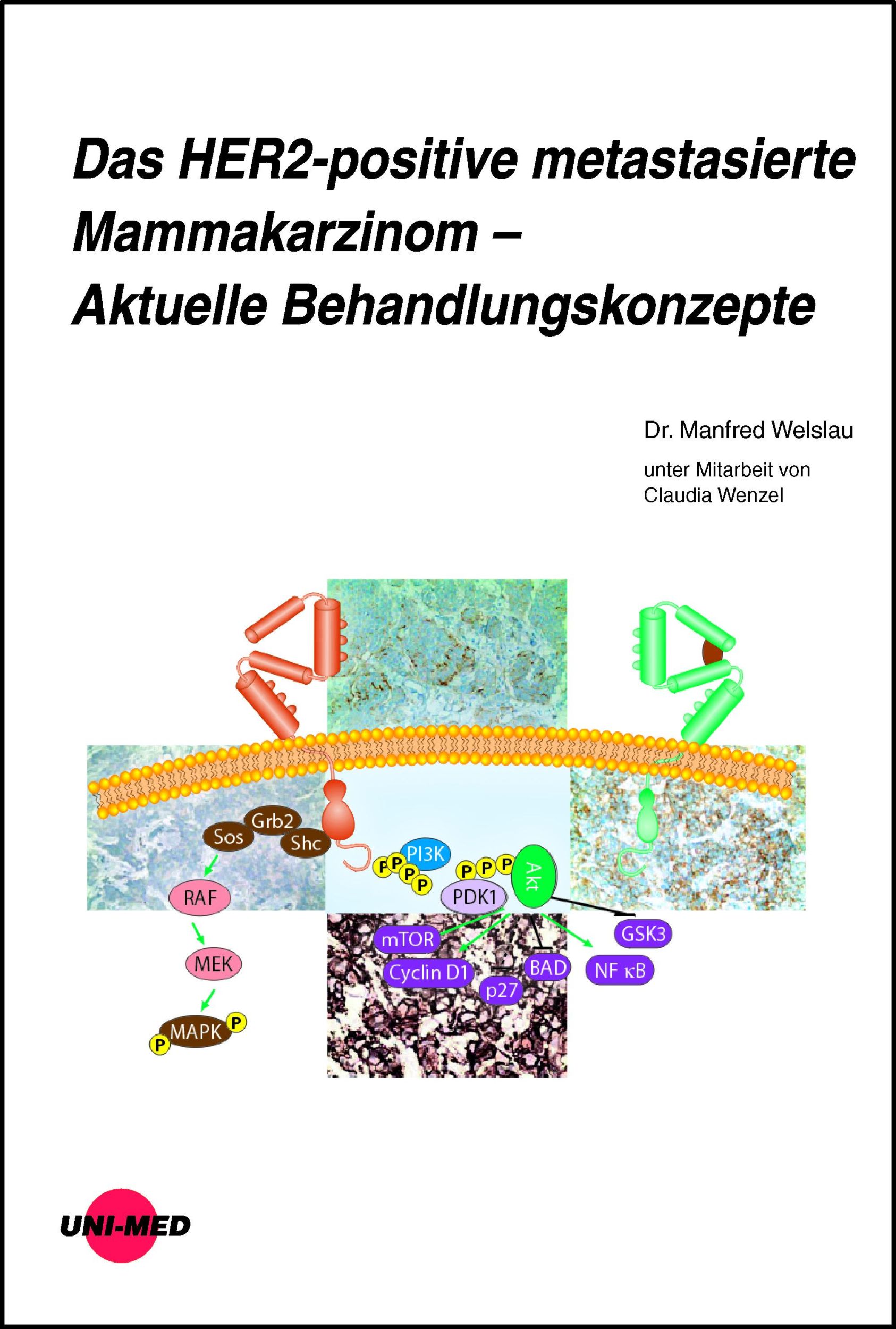 Cover: 9783837424454 | Das HER2-positive metastasierte Mammakarzinom - Aktuelle...