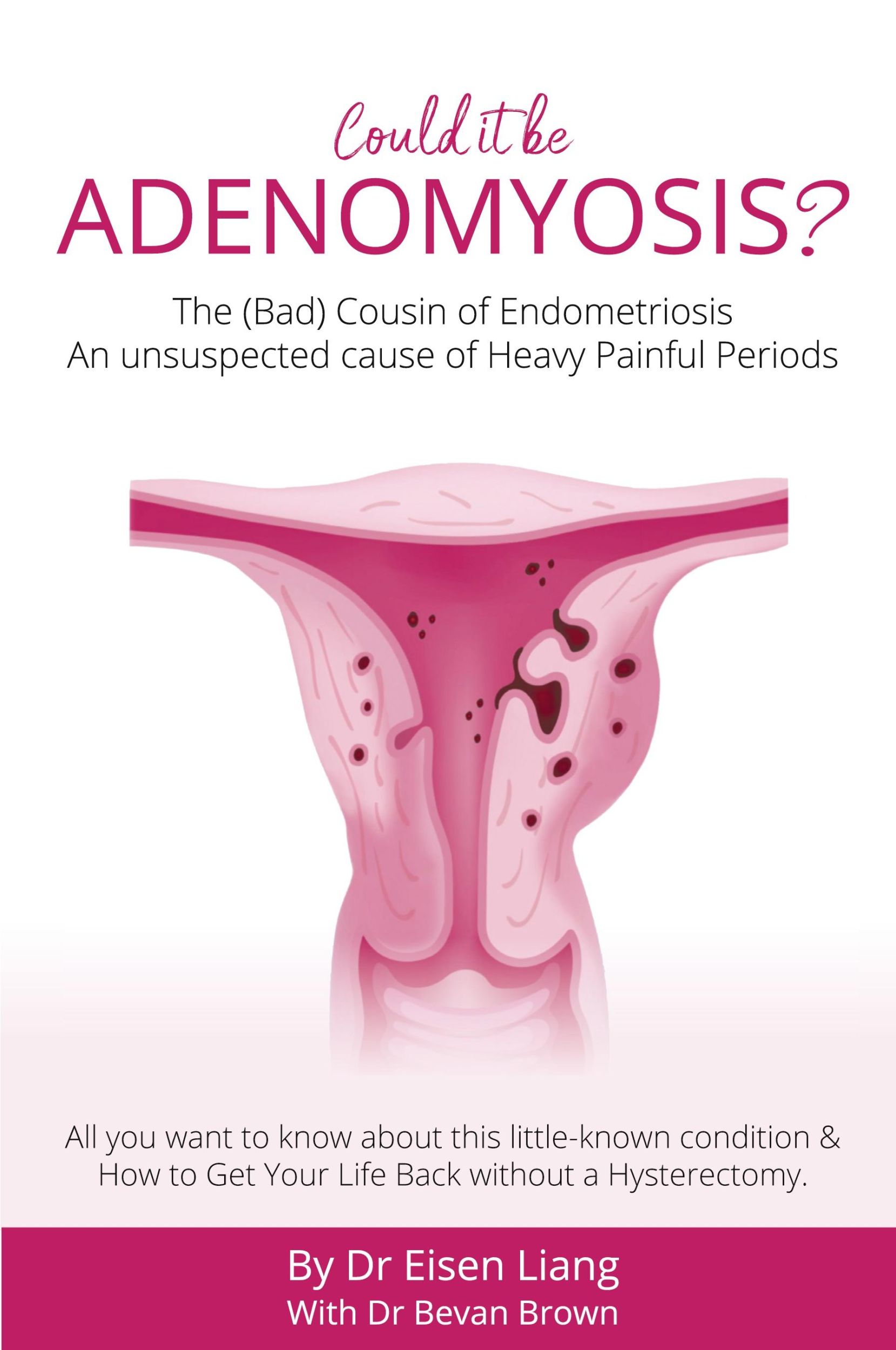 Cover: 9781925471564 | Adenomyosis -The Bad Cousin of Endometriosis | Eisen Liang (u. a.)