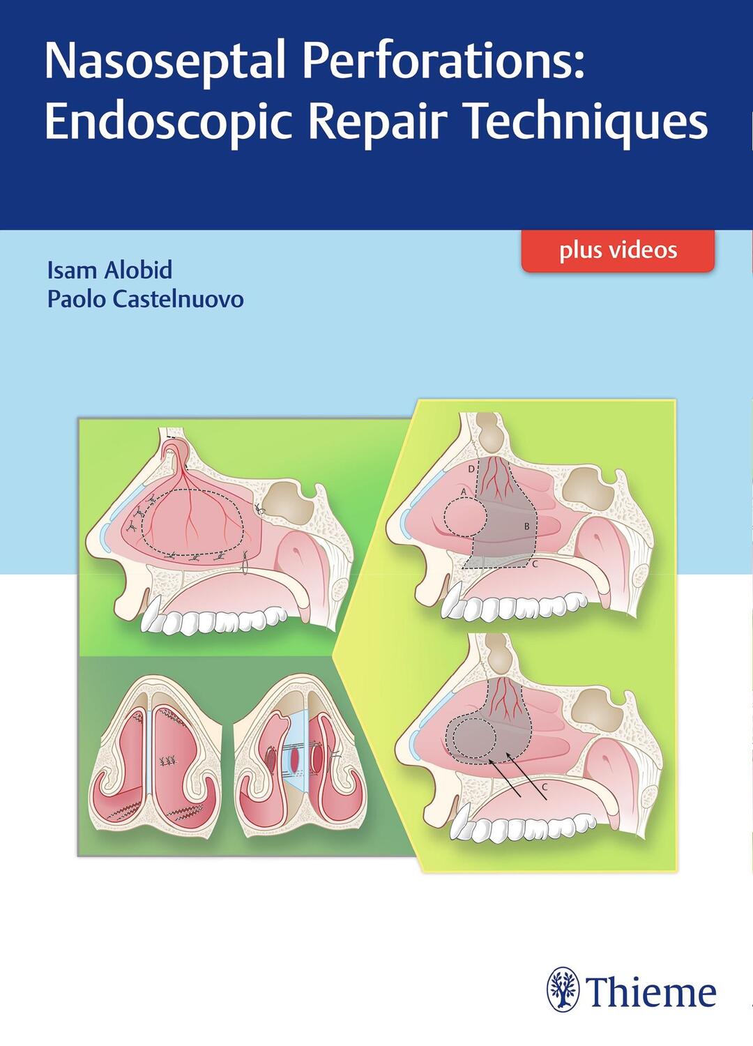 Cover: 9783132053915 | Nasoseptal Perforations: Endoscopic Repair Techniques | Alobid (u. a.)