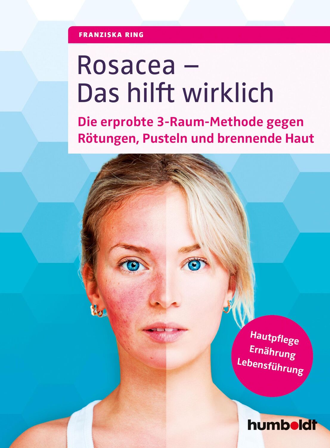 Cover: 9783869100524 | Rosacea - Das hilft wirklich | Franziska Ring | Taschenbuch | 160 S.