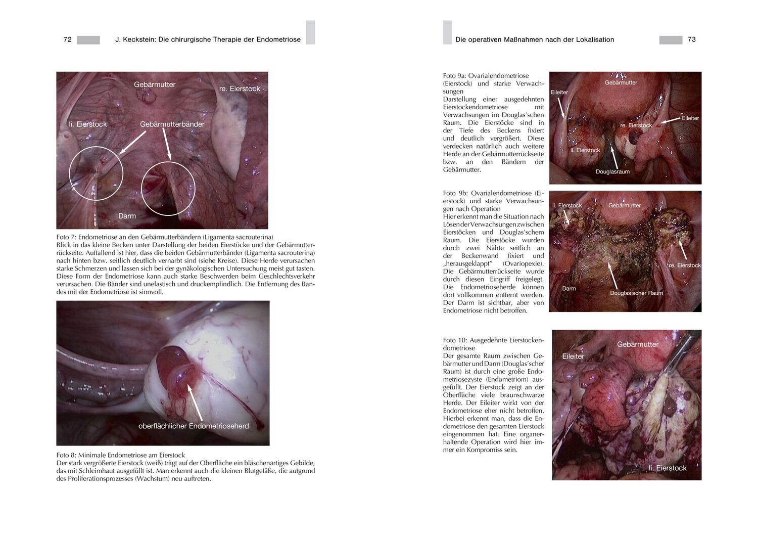 Bild: 9783938580738 | Endometriose - Die verkannte Frauenkrankheit | Jörg Keckstein | Buch