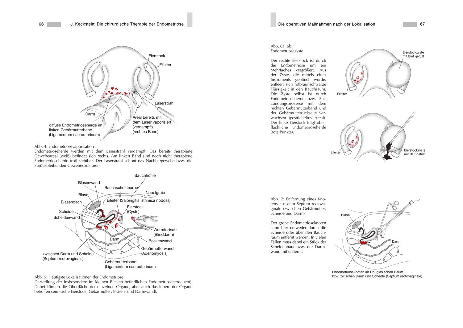 Bild: 9783938580738 | Endometriose - Die verkannte Frauenkrankheit | Jörg Keckstein | Buch