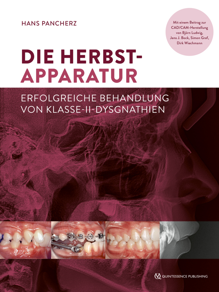 Cover: 9783868675849 | Die Herbst-Apparatur | Hans Pancherz | Buch | 192 S. | Deutsch | 2022