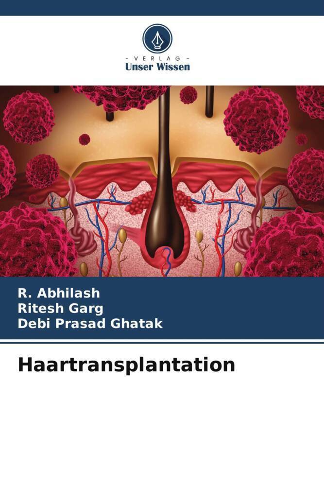 Cover: 9786206994930 | Haartransplantation | R. Abhilash (u. a.) | Taschenbuch | Paperback