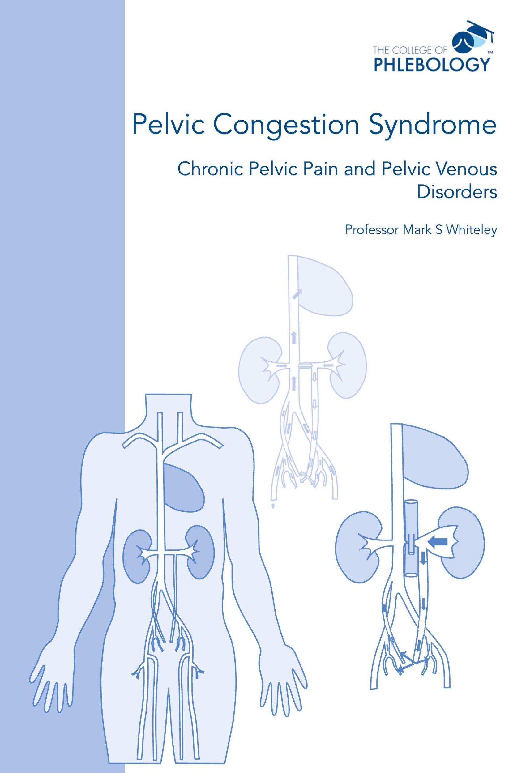 Cover: 9781908586070 | Pelvic Congestion Syndrome - Chronic Pelvic Pain and Pelvic Venous...