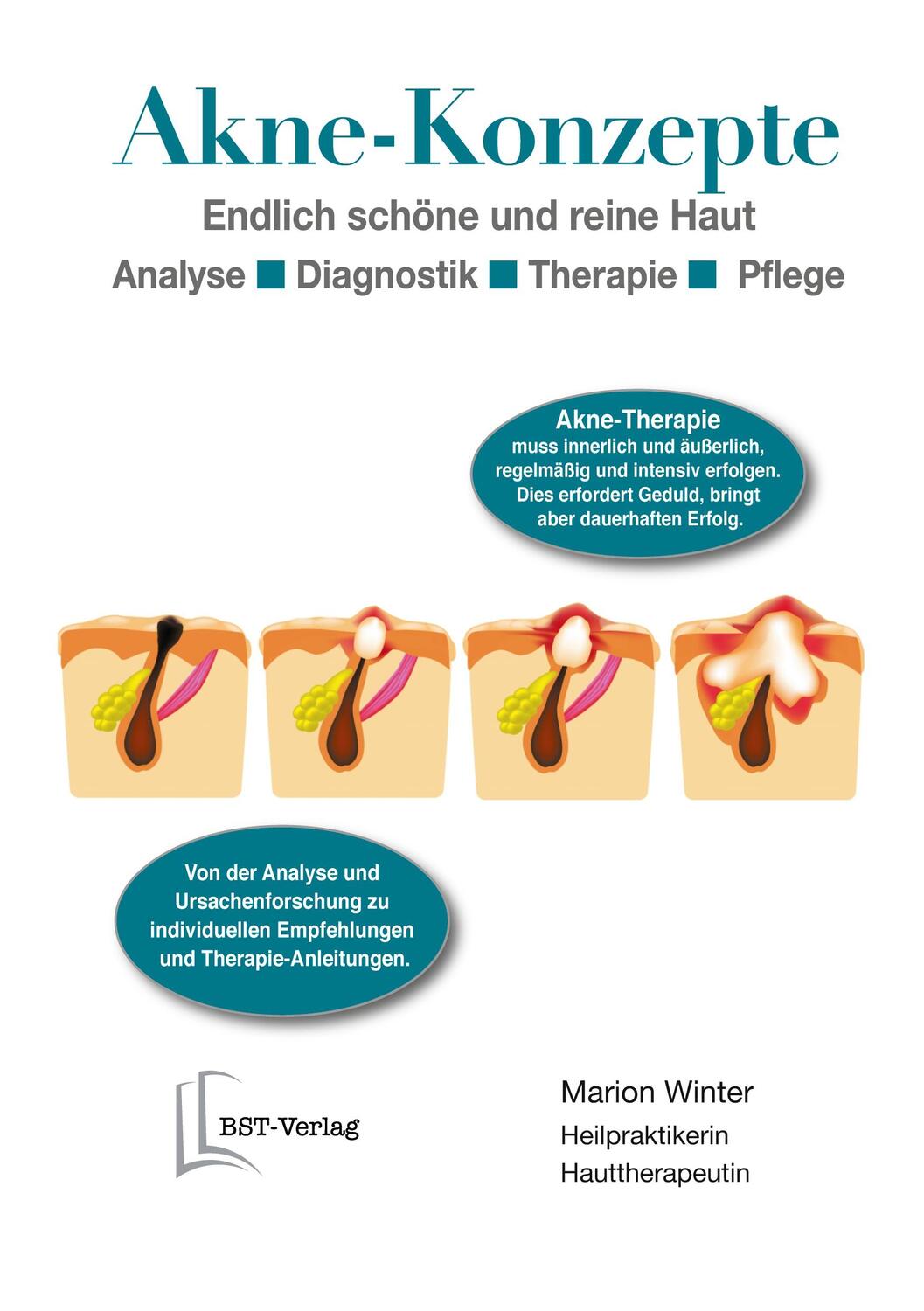 Cover: 9783753476131 | Akne-Konzepte | Endlich schöne und reine Haut | Marion Winter | Buch