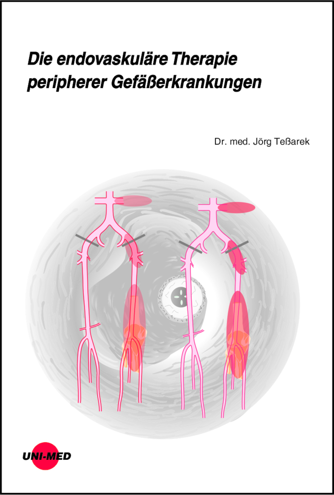 Cover: 9783837416343 | Die endovaskuläre Therapie peripherer Gefäßerkrankungen | Jörg Teßarek