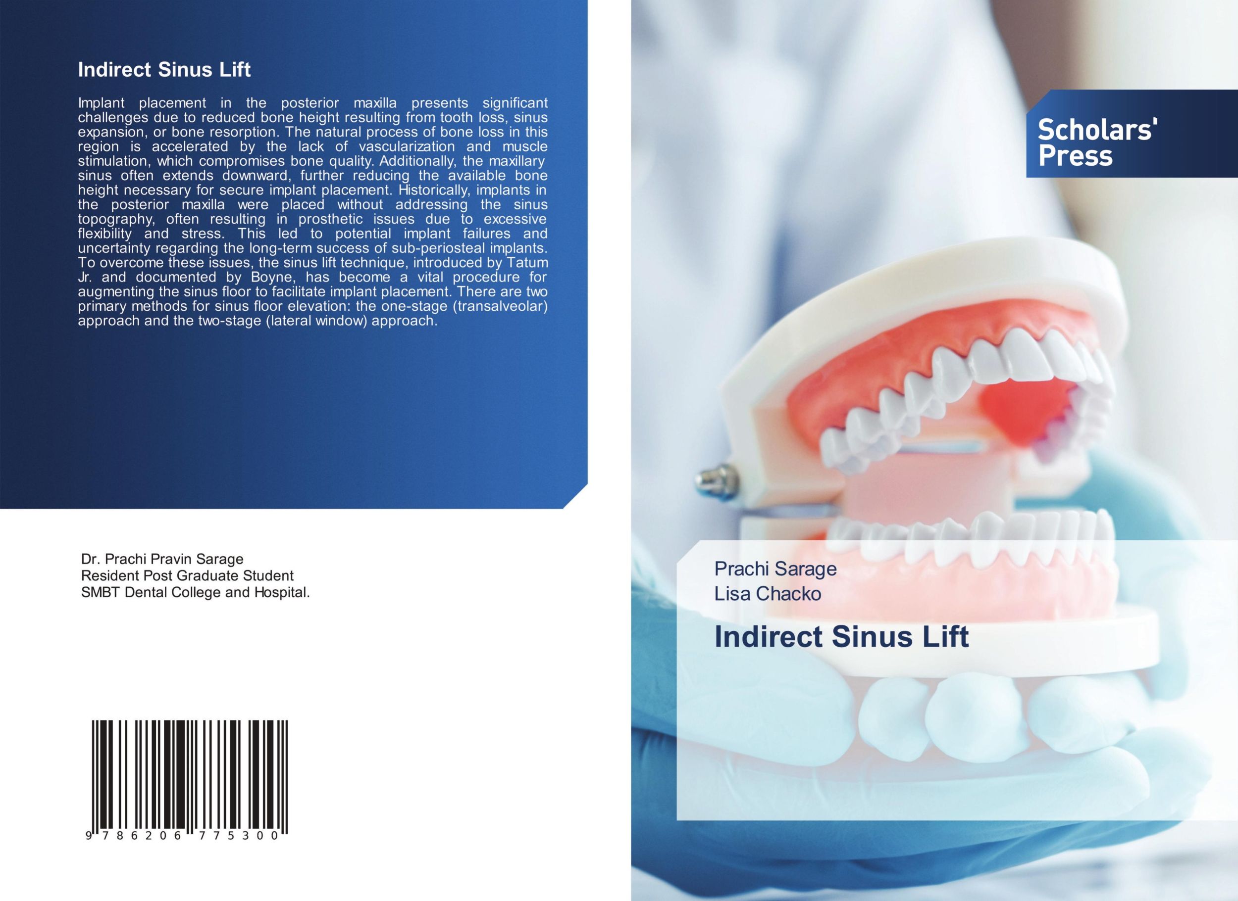 Cover: 9786206775300 | Indirect Sinus Lift | Prachi Sarage (u. a.) | Taschenbuch | Englisch