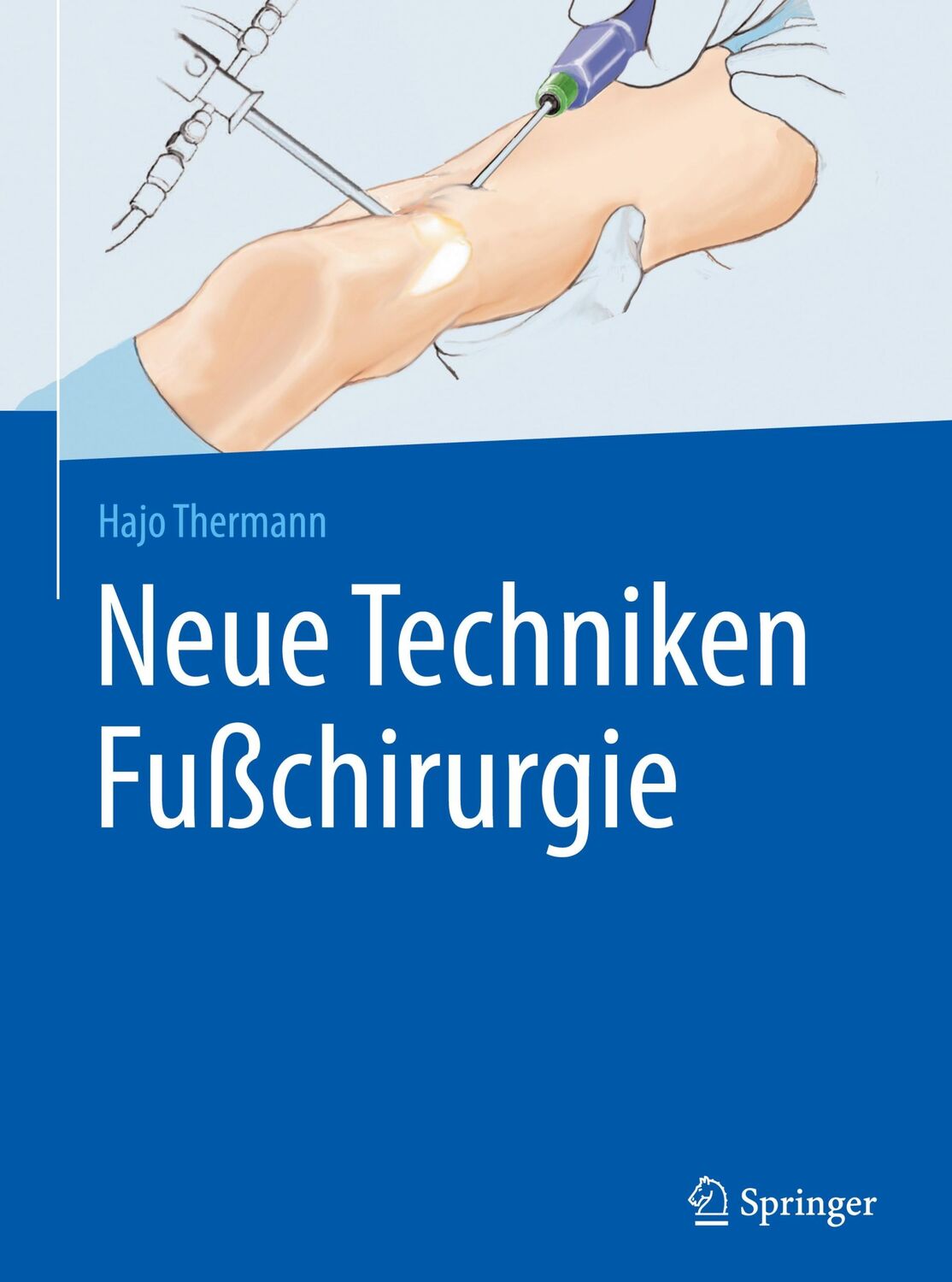 Cover: 9783662527368 | Neue Techniken Fußchirurgie | Hajo Thermann | Buch | xii | Deutsch