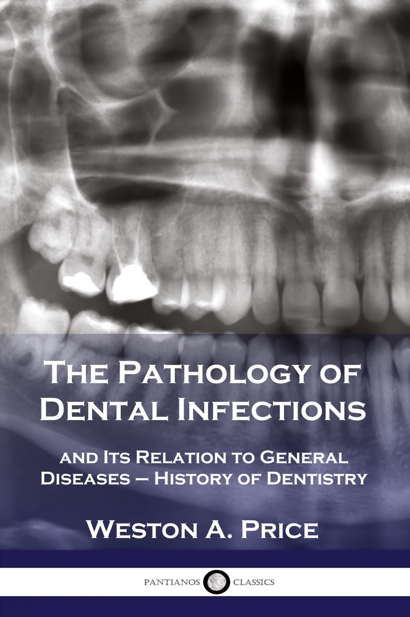 Cover: 9781789872279 | The Pathology of Dental Infections | Weston A. Price | Taschenbuch